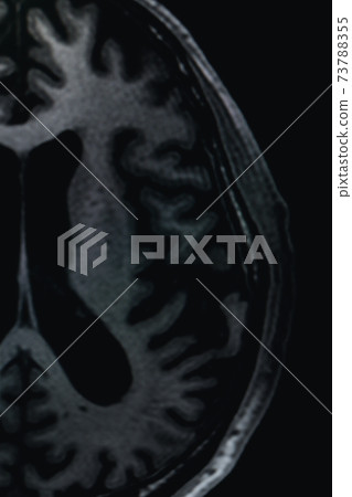 MRI of brain Dementia protocol with Alzheimer's disease  Take a picture from the computer  73788355
