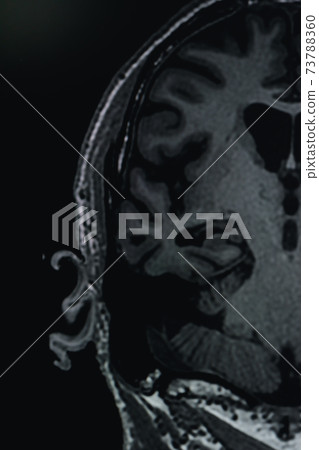 MRI of brain Dementia protocol with Alzheimer's disease  Take a picture from the computer  73788360
