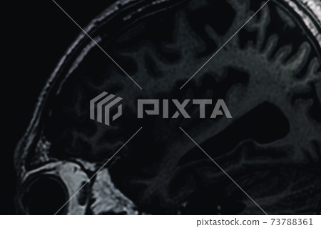 MRI of brain Dementia protocol with Alzheimer's disease  Take a picture from the computer  73788361