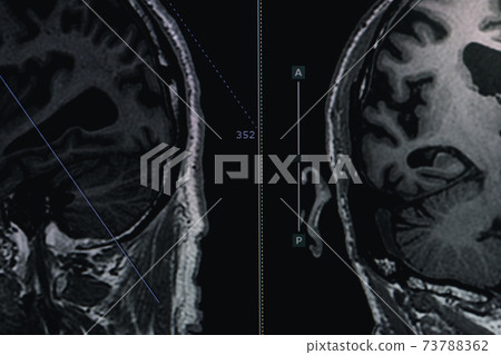 MRI of brain Dementia protocol with Alzheimer's disease Take a picture from the computer MRI of brain Dementia protocol with Alzheimer's disease Take a picture from the computer 73788362