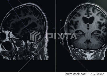 MRI of brain Dementia protocol with Alzheimer's disease Take a picture from the computer MRI of brain Dementia protocol with Alzheimer's disease Take a picture from the computer 73788364