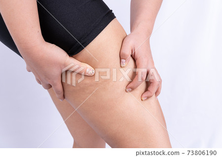 Female holding and pushing the skin of the legs cellulite, orange peel. Treatment and disposal of excess weight, the deposition of subcutaneous fat tissue Female holding and pushing the skin of the legs cellulite, orange peel. Treatment and disposal of excess weight, the deposition of subcutaneous fat tissue 73806190