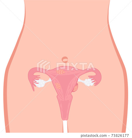 Uterine Fibroid vector illustration. Gynecology problem. Tumor in female reproductive organ 73826177