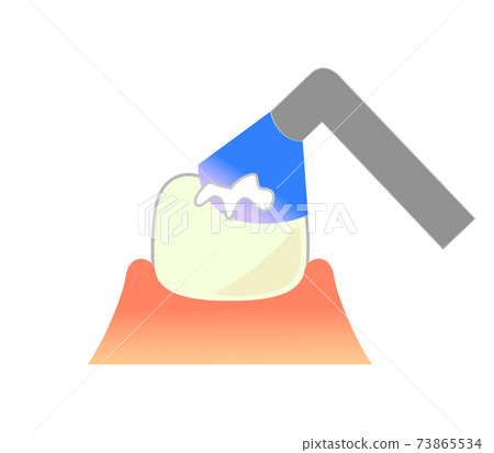 Illustration of composite resin CR adhesive restoration method 73865534