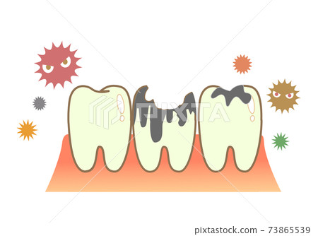 Caries and Periodontal Disease: Dental Illustration 73865539