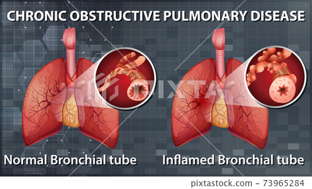 Chronic obstructive pulmonary disease Chronic obstructive pulmonary disease 73965284