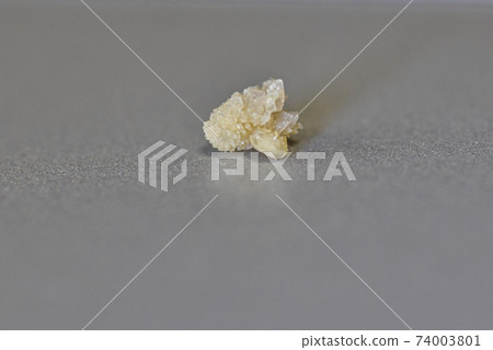 輸尿管結石終於被崇拜 74003801