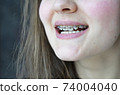 The girl is smiling, braces are installed 74004040