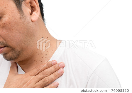 Closed up the Skin Tags or Acrochordon on neck man isolated on white 74008330