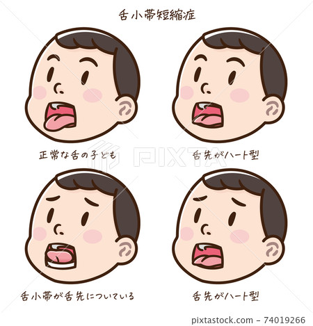 Illustration of a child with ankyloglossia Illustration of a child with ankyloglossia 74019266