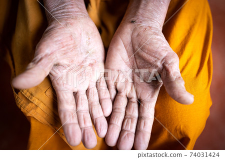 Psoriasis,Atopic dermatitis,dry skin,rash and red mark from scratching and itching on the skin of patient's hand,cracked skin,dermatological problem,wounds on the palms,severe allergic,chronic disease 74031424