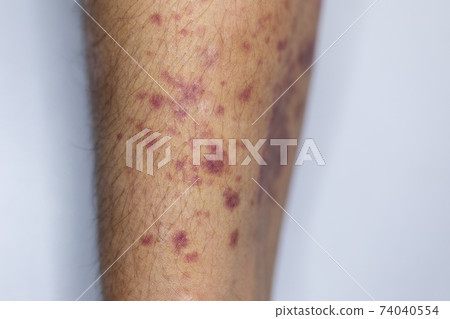 The physical appearance of the arm with the wound is caused by Haemophilia, (Haemophiliais a mostly inherited genetic disorder) The physical appearance of the arm with the wound is caused by Haemophilia, (Haemophiliais a mostly inherited genetic disorder) 74040554