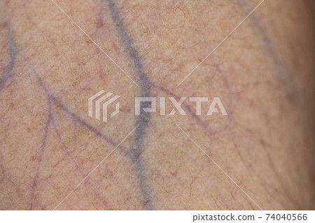 The physical appearance of the arm with the wound is caused by Haemophilia, (Haemophiliais a mostly inherited genetic disorder) 74040566
