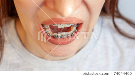 Braces in the smiling mouth of a girl. Smooth teeth from braces. Braces in the smiling mouth of a girl. Smooth teeth from braces. 74044460