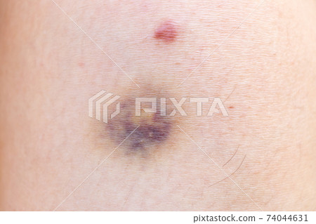 Closed up background of violet lesion on asian woman skin 74044631