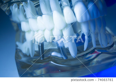 Dental tooth implant 74083781