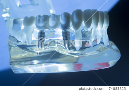 Dental tooth implant 74083823