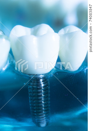Dental tooth implant 74083847