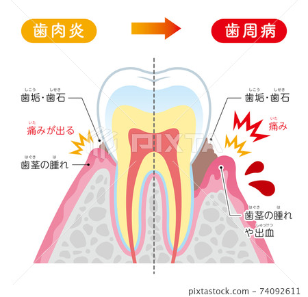 肺泡膿性插圖的解釋 74092611
