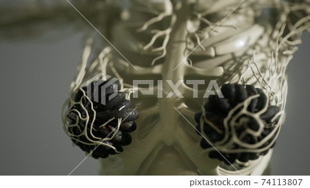 medical scan of Woman Breast Cancer 74113807