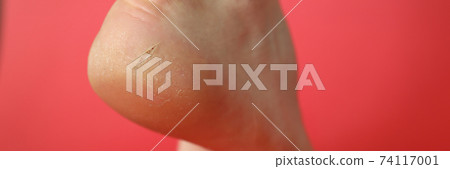Dermatology problem and dryness Dermatology problem and dryness 74117001