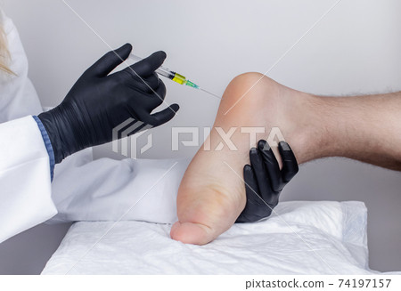 An orthopedic surgeon gives an injection in the heel to relieve pain from a heel spur. The concept of medical care and non-surgical treatments. An orthopedic surgeon gives an injection in the heel to relieve pain from a heel spur. The concept of medical care and non-surgical treatments. 74197157