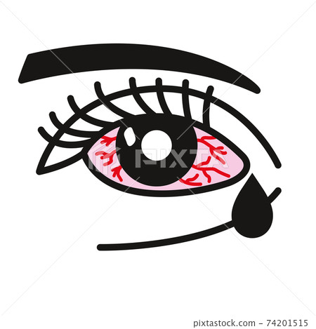 Inflammated eye Conjunctivitis or pink eye Inflammated eye Conjunctivitis or pink eye 74201515