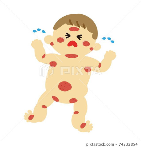Baby rough skin itchy 74232854