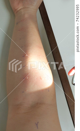 Arm examine with allergy skin prick test rash reaction aero dust mite sensitive 74232995