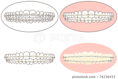 陶瓷支架安裝套件，用於正確的牙齒和正畸治療 74236433