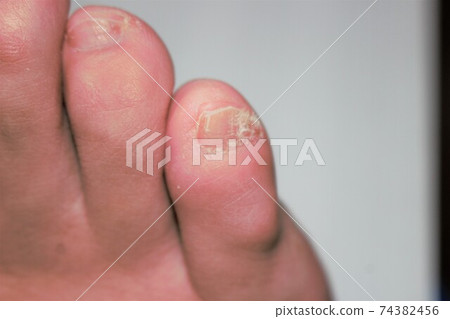 Deformed female toe little finger Deformed female toe little finger 74382456