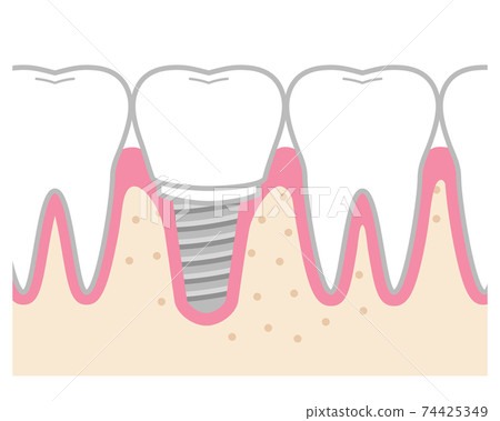 Tooth implant 74425349
