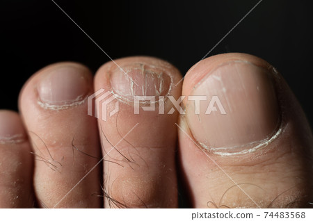 Close-up of male toes with a cracked nail Close-up of male toes with a cracked nail 74483568