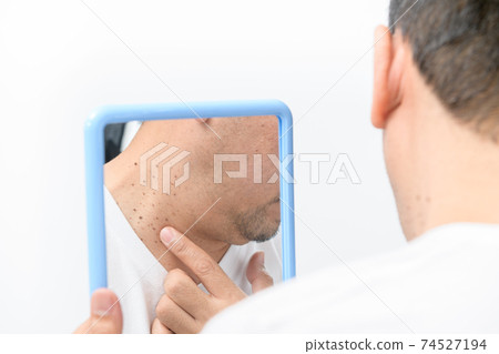 Asian middle man looks in the mirror and point to Skin Tags or Acrochordon on neck Asian middle man looks in the mirror and point to Skin Tags or Acrochordon on neck 74527194