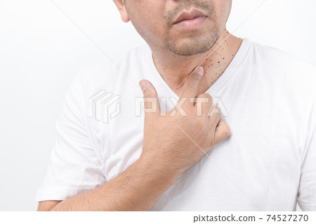 Man point to Skin Tags or Acrochordon on neck man on white background. Man point to Skin Tags or Acrochordon on neck man on white background. 74527270