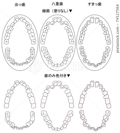 Top view of typical cases targeted for orthodontic treatment Top view of typical cases targeted for orthodontic treatment 74527564