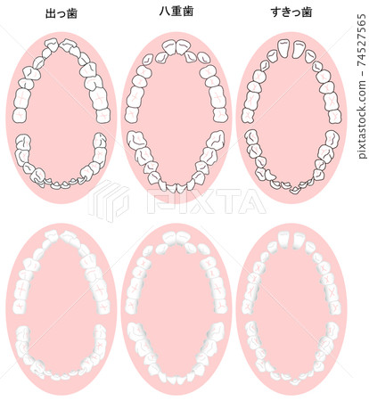 Top view of typical cases targeted for orthodontic treatment Color 74527565