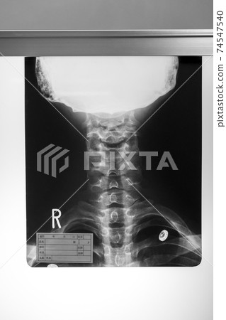x光透射片 骨頭 骨骼 74547540
