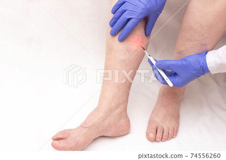 A phlebologist holds a scalpel near the patient's leg of a woman who has varicose veins in her legs. Concept of modern vein removal with phlebectomy, copy space 74556260