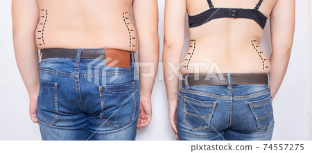 Married couple man and girl with obesity on their sides. Concept of plastic surgery to remove fat on the abdomen and sides, liposuction, beauty saloon Married couple man and girl with obesity on their sides. Concept of plastic surgery to remove fat on the abdomen and sides, liposuction, beauty saloon 74557275