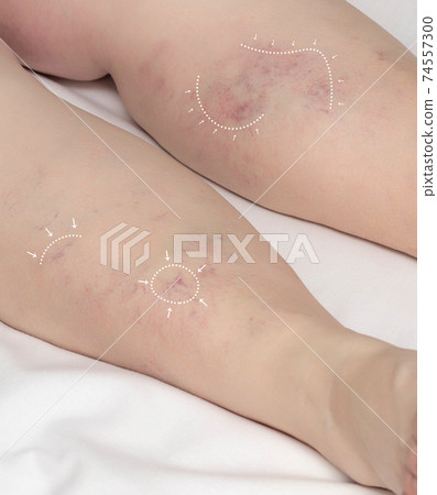 Markers on the legs of a woman before surgery to treat and remove leg veins. The concept of treatment of varicose veins and thrombophlebitis, phlebology and phlebectomy 74557300