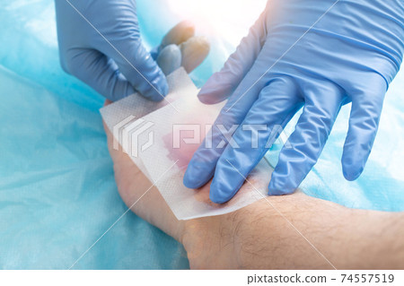 The doctor removes hair from toes with epilating wax strips. Hygiene and cosmetology concept, close-up The doctor removes hair from toes with epilating wax strips. Hygiene and cosmetology concept, close-up 74557519