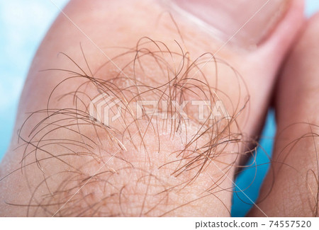 Hair on a toe of a man, macro. Hygiene concept for hair removal. Chemical depilation Hair on a toe of a man, macro. Hygiene concept for hair removal. Chemical depilation 74557520