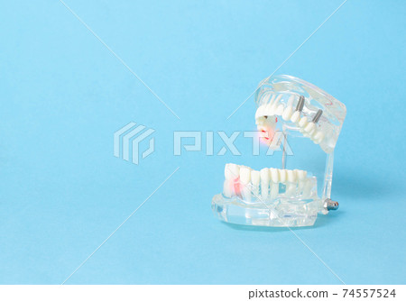 Dental jaw model on a blue background. Dental disease concept, inflammation and pain, gum redness. Copy space for text 74557524