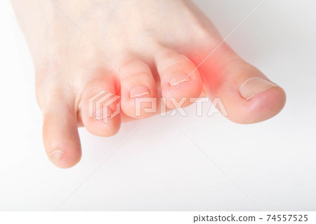 A crooked and stiff toe on a white background. Interdigital neuralgia, macro, copy space for text A crooked and stiff toe on a white background. Interdigital neuralgia, macro, copy space for text 74557525
