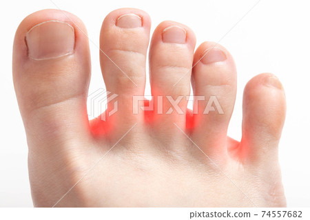 Redness between the toes, onychomycosis, macro. Foot fungus disease treatment concept, dermatitis 74557682