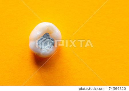 Tooth with a filling close-up on a yellow background Tooth with a filling close-up on a yellow background 74564820