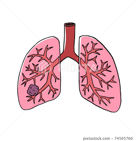 Image of lung cancer 74565760