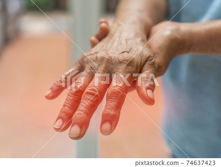 Peripheral Neuropathy pain in elderly patient on hand, palm, fingers and sensory nerves with numb, aching, muscle weakness, stabbing, burning from chronic inflammatory demyelinating polyneuropathy 74637423