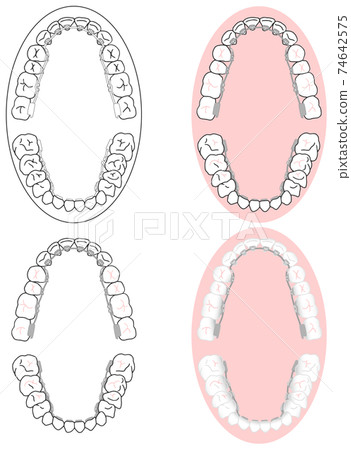 Metal bracket mounting set for correct teeth and backside orthodontics for orthodontics Metal bracket mounting set for correct teeth and backside orthodontics for orthodontics 74642575